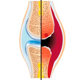Η δομή μιας υγιούς και φθαρμένης άρθρωσης με τον χαρακτηρισμό του χόνδρινου ιστού και του αρθρικού υγρού