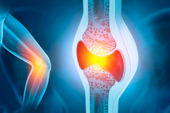 Πρόληψη παθήσεων των αρθρώσεων