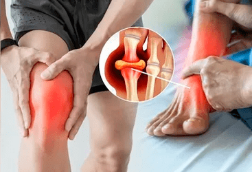 Σχέδιο εφαρμογής γέλης Icexin στην περιοχή της άρθρωσης του γόνατος και του ποδιού